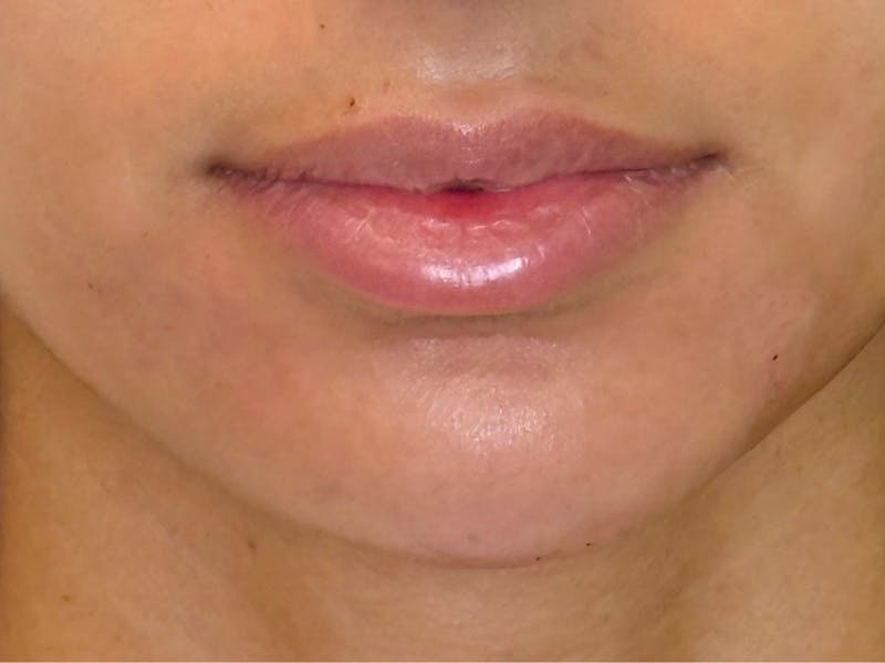 Facial Filler Before & After Gallery - Patient 539544 - Image 4