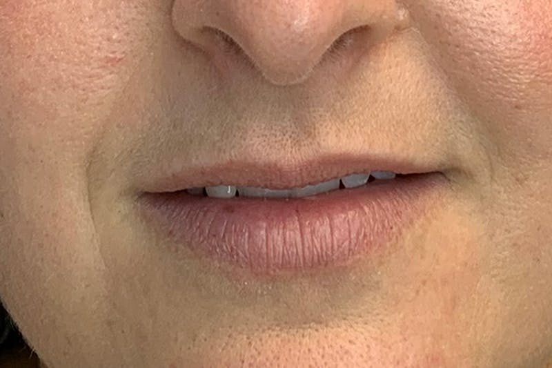 Lip Filler Before & After Gallery - Patient 220816 - Image 1