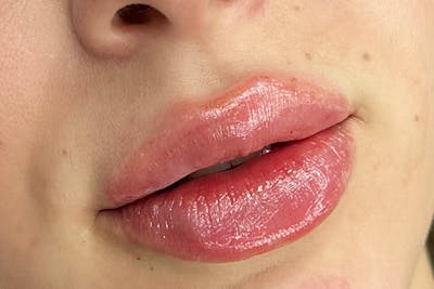 Lip Filler Before & After Gallery - Patient 312157 - Image 2