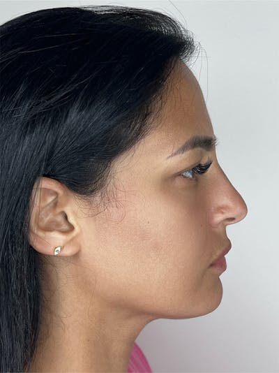 Facial Filler Before & After Gallery - Patient 141862 - Image 1
