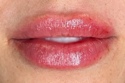 Lip Filler Before & After Gallery - Patient 384414 - Image 2