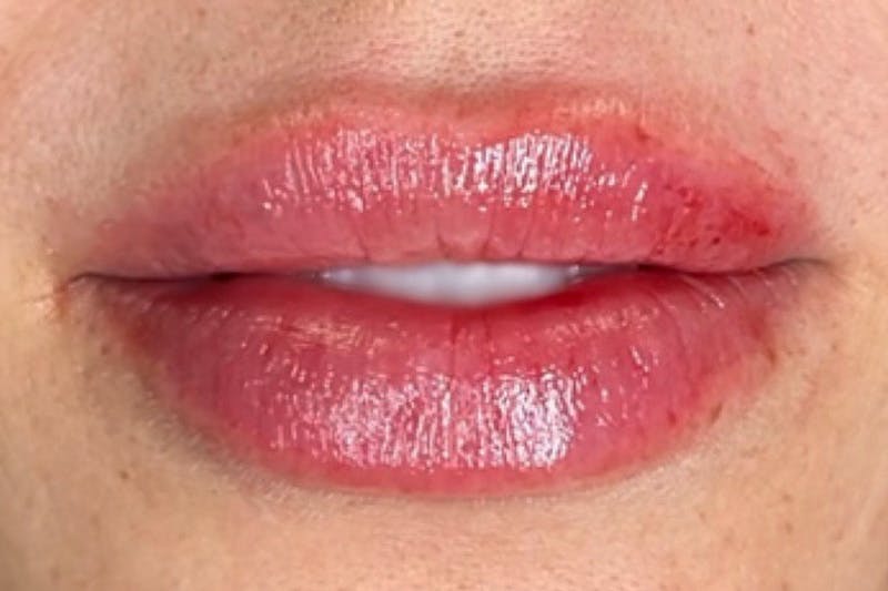 Lip Filler Before & After Gallery - Patient 384414 - Image 2