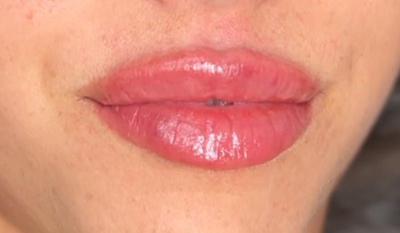 Lip Filler Before & After Gallery - Patient 425516 - Image 4