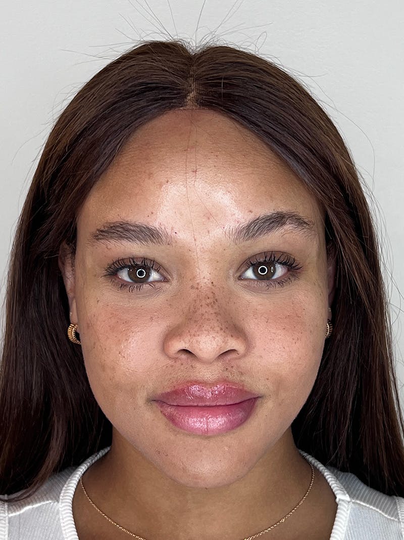 Facial Filler Before & After Gallery - Patient 183335 - Image 2