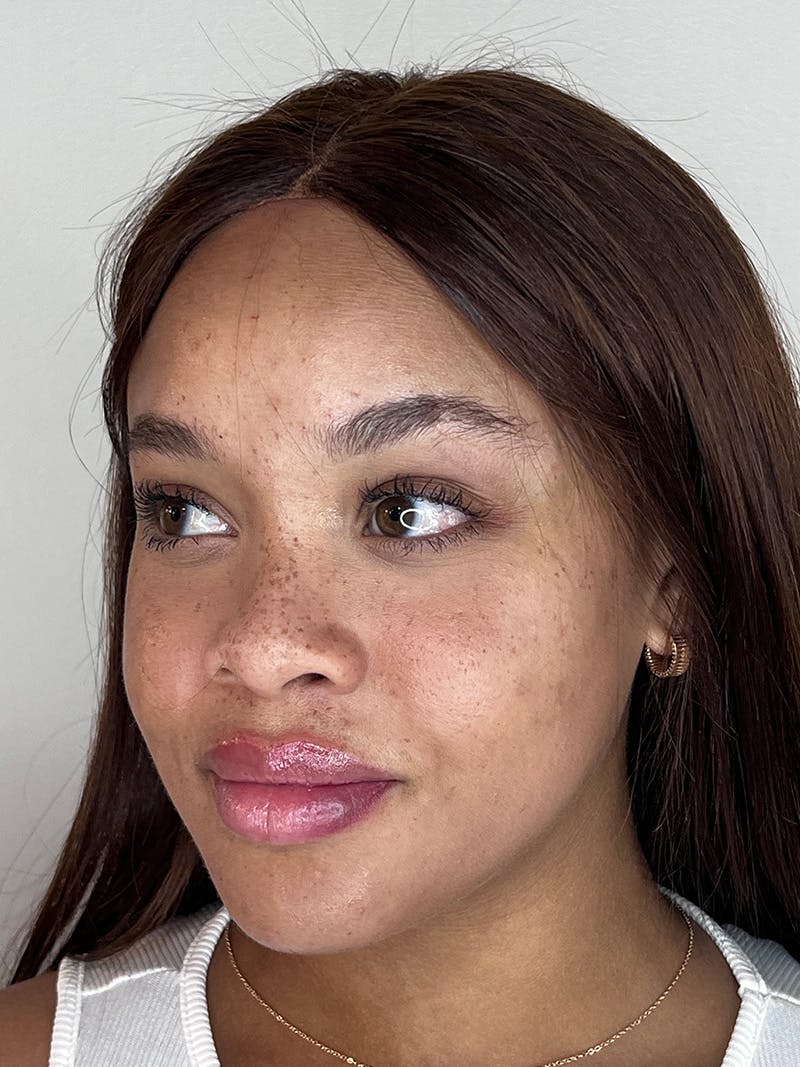 Facial Filler Before & After Gallery - Patient 183335 - Image 4