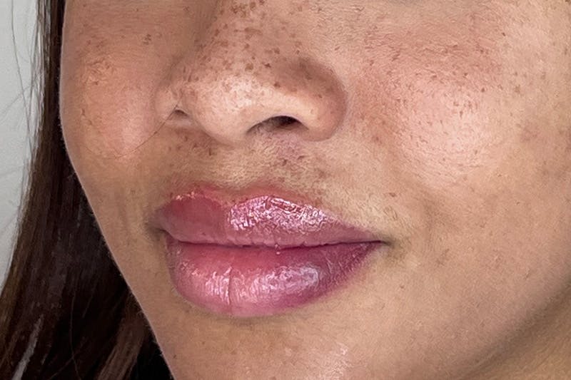 Lip Filler Before & After Gallery - Patient 169040 - Image 4