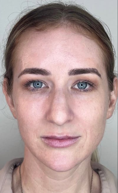 Facial Filler Before & After Gallery - Patient 602048 - Image 2