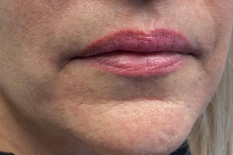 Lip Filler Before & After Gallery - Patient 406528 - Image 3