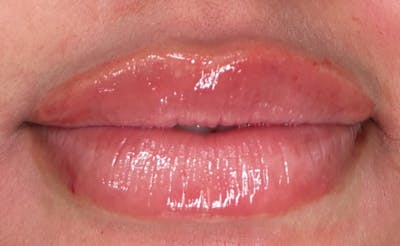 Lip Filler Before & After Gallery - Patient 920619 - Image 2