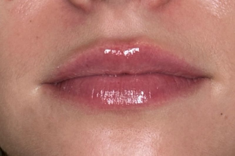 Lip Filler Before & After Gallery - Patient 253524 - Image 2