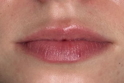 Lip Filler Before & After Gallery - Patient 253524 - Image 1