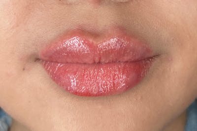 Lip Filler Before & After Gallery - Patient 134220 - Image 2