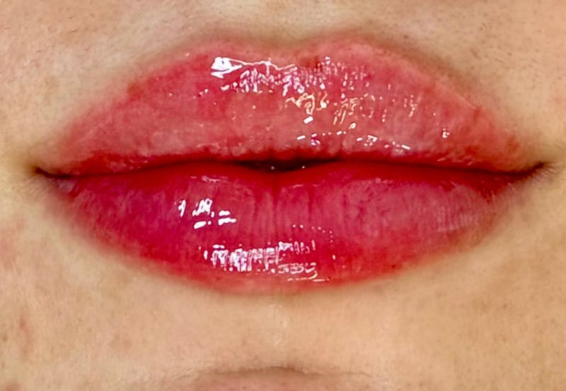 Lip Filler Before & After Gallery - Patient 780844 - Image 2