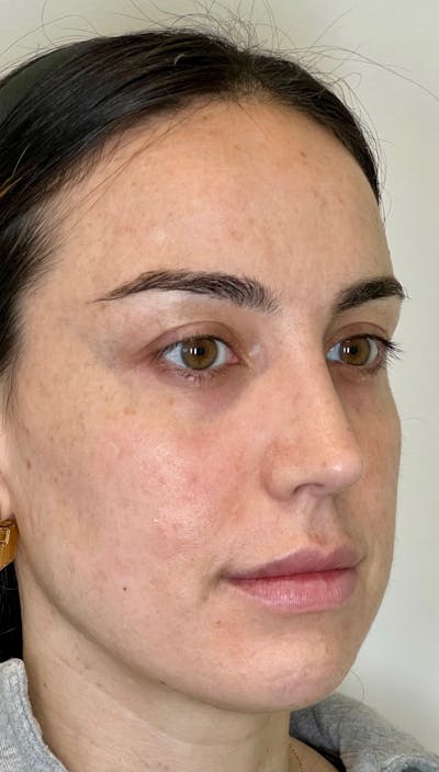 Facial Filler Before & After Gallery - Patient 146785 - Image 1