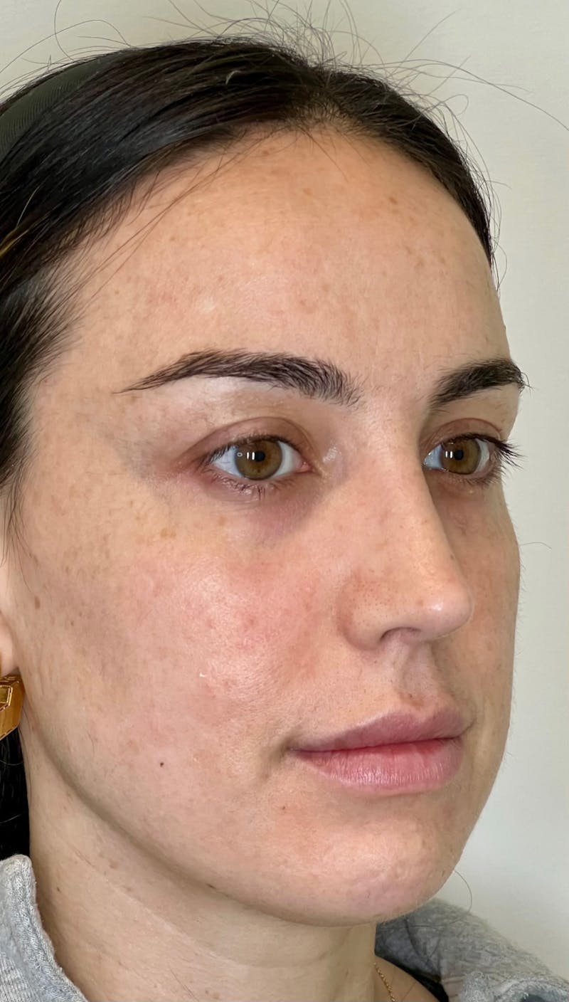 Facial Filler Before & After Gallery - Patient 146785 - Image 1