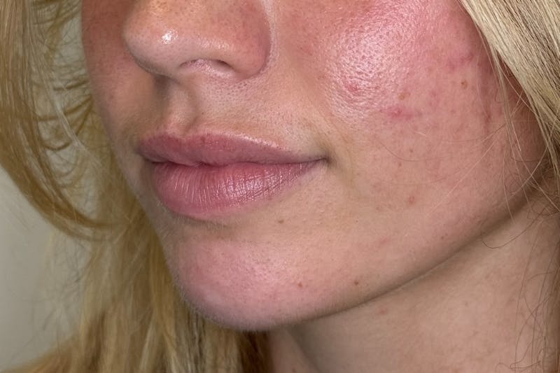 Facial Filler Before & After Gallery - Patient 324708 - Image 1