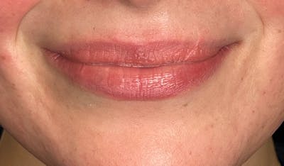 Lip Filler Before & After Gallery - Patient 277608 - Image 1