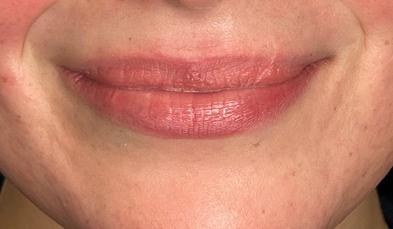 Lip Filler Before & After Gallery - Patient 277608 - Image 1