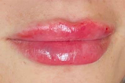 Lip Filler Before & After Gallery - Patient 245062 - Image 2