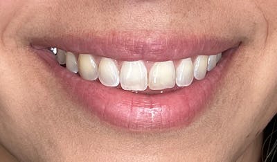 Lip Filler Before & After Gallery - Patient 425516 - Image 1