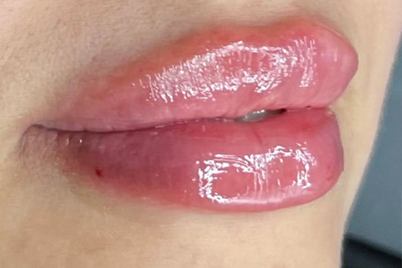 Lip Filler Before & After Gallery - Patient 242971 - Image 4