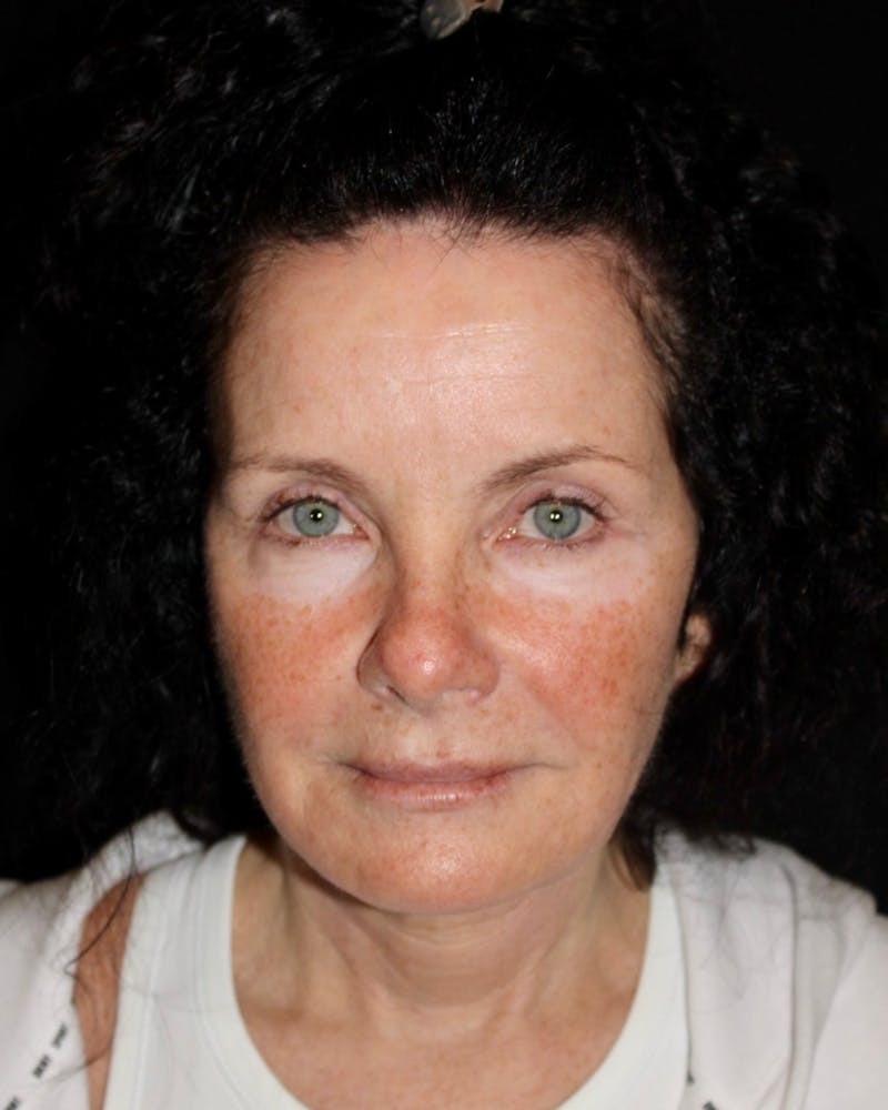 Facelift Before & After Gallery - Patient 285891 - Image 1