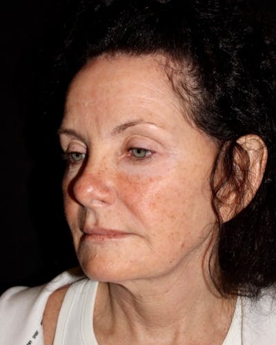 Neck Lift Before & After Gallery - Patient 155350 - Image 1