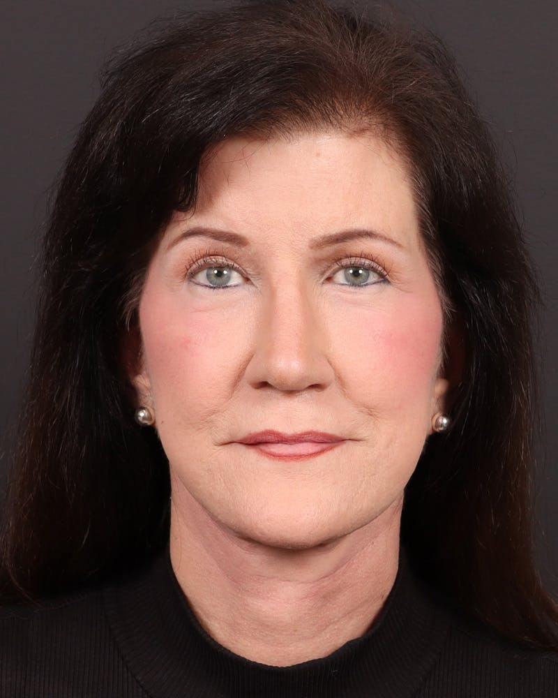 Facelift Before & After Gallery - Patient 116970 - Image 2