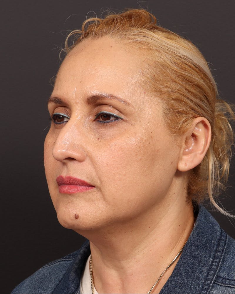 Facelift Before & After Gallery - Patient 104845 - Image 1