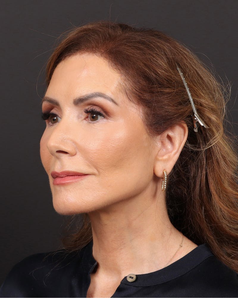 Facelift Before & After Gallery - Patient 839916 - Image 4