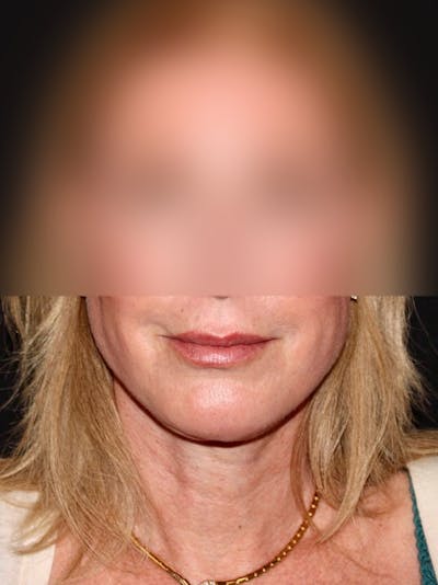 Facelift Before & After Gallery - Patient 355862 - Image 2