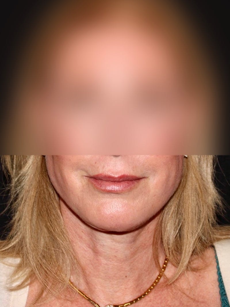 Facelift Before & After Gallery - Patient 355862 - Image 2