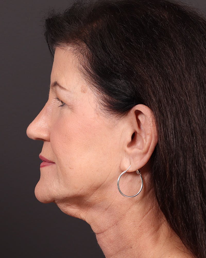 Facelift Before & After Gallery - Patient 116970 - Image 5