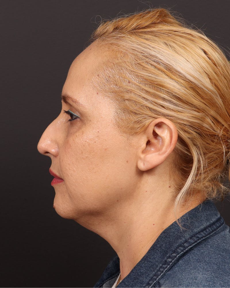 Facelift Before & After Gallery - Patient 104845 - Image 3