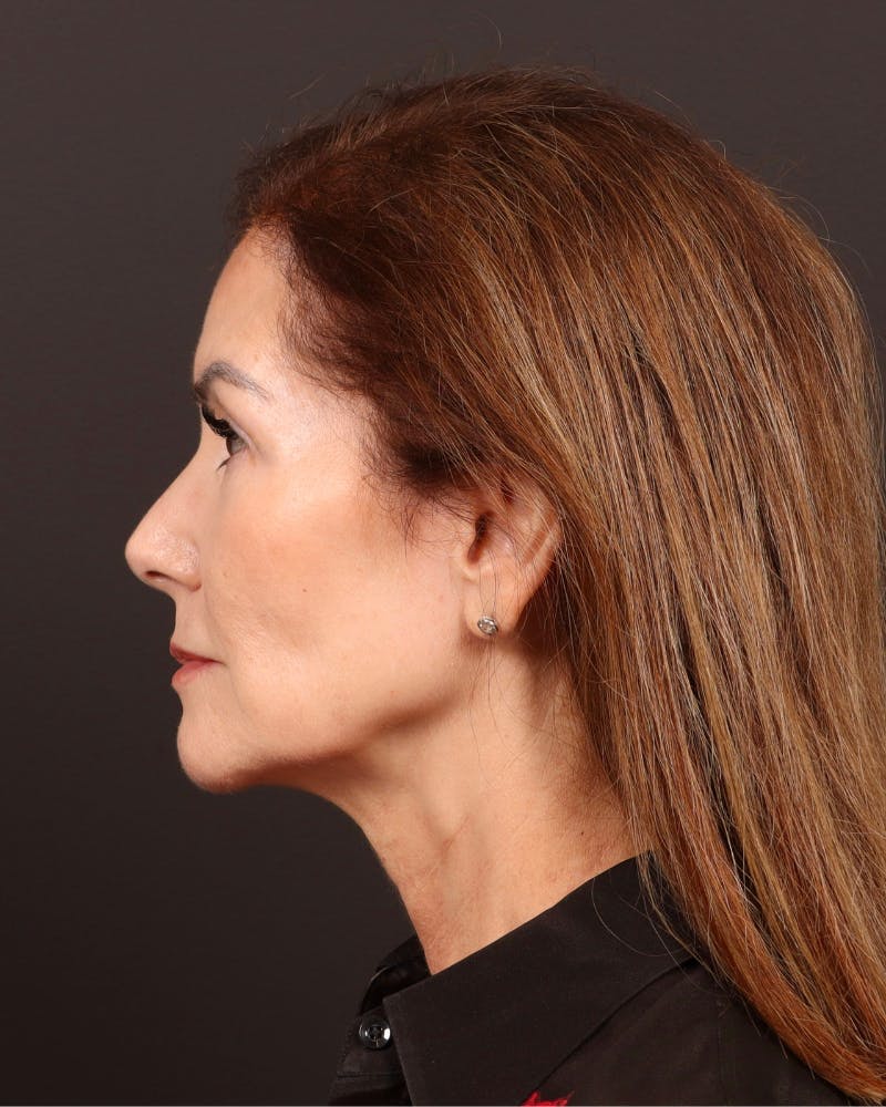 Facelift Before & After Gallery - Patient 839916 - Image 5