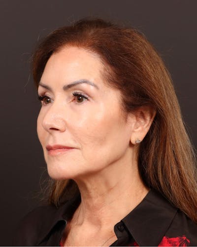 Neck Lift Before & After Gallery - Patient 181775 - Image 1