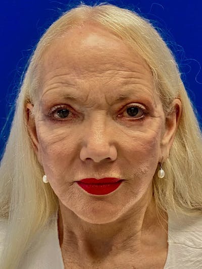 Facelift Before & After Gallery - Patient 326906 - Image 2
