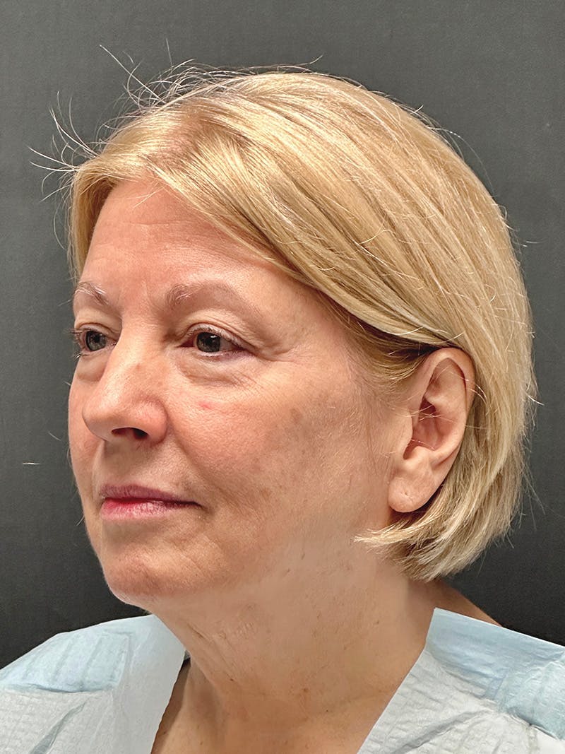 Facelift Before & After Gallery - Patient 119611 - Image 3