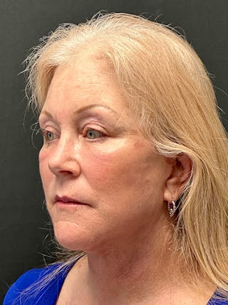 Facelift Before & After Gallery - Patient 104254 - Image 4