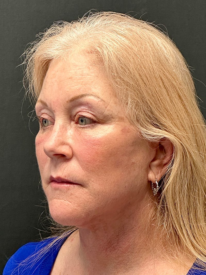 Facelift Before & After Gallery - Patient 104254 - Image 4