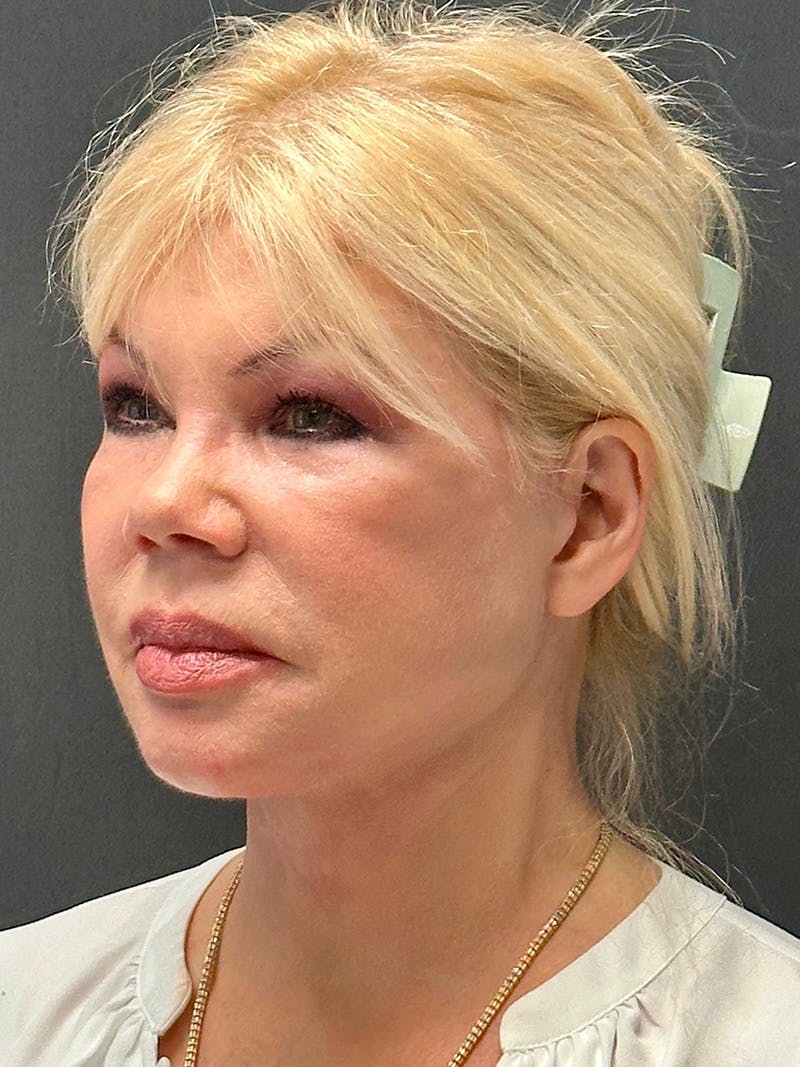 Facelift Before & After Gallery - Patient 112257 - Image 4
