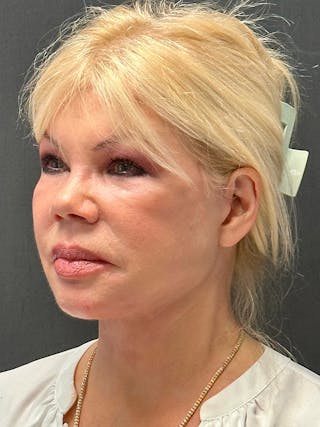 Facelift Before & After Gallery - Patient 112257 - Image 4