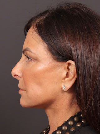 Neck Lift Before & After Gallery - Patient 362491 - Image 6