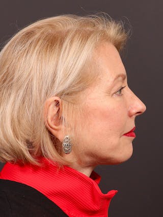 Facelift Before & After Gallery - Patient 119611 - Image 6