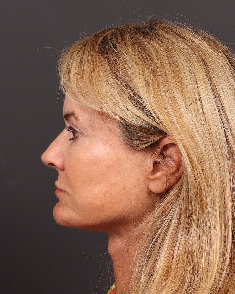 Facelift Before & After Gallery - Patient 287189 - Image 2