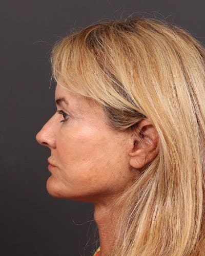 Facelift Before & After Gallery - Patient 287189 - Image 2