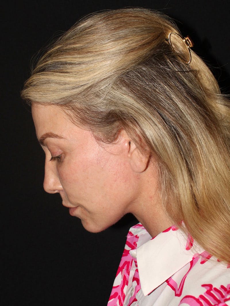 Facelift Before & After Gallery - Patient 420053 - Image 8