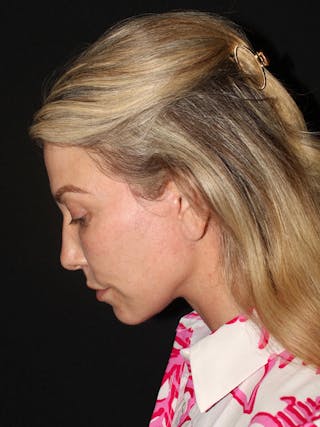 Facelift Before & After Gallery - Patient 420053 - Image 8