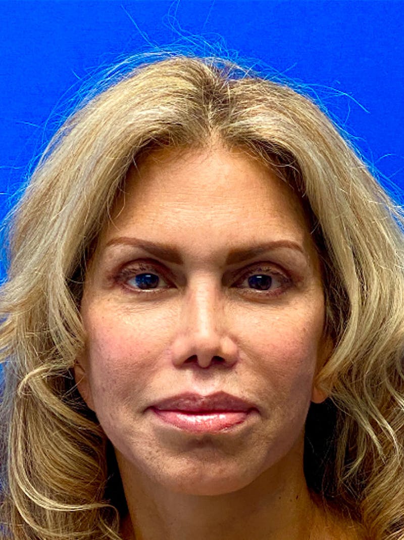 Brow Lift  Before & After Gallery - Patient 140942 - Image 2