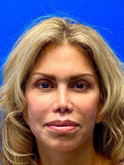 Facelift Before & After Gallery - Patient 214160 - Image 2